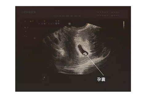 孕囊形状图片_39健康网_精编内容